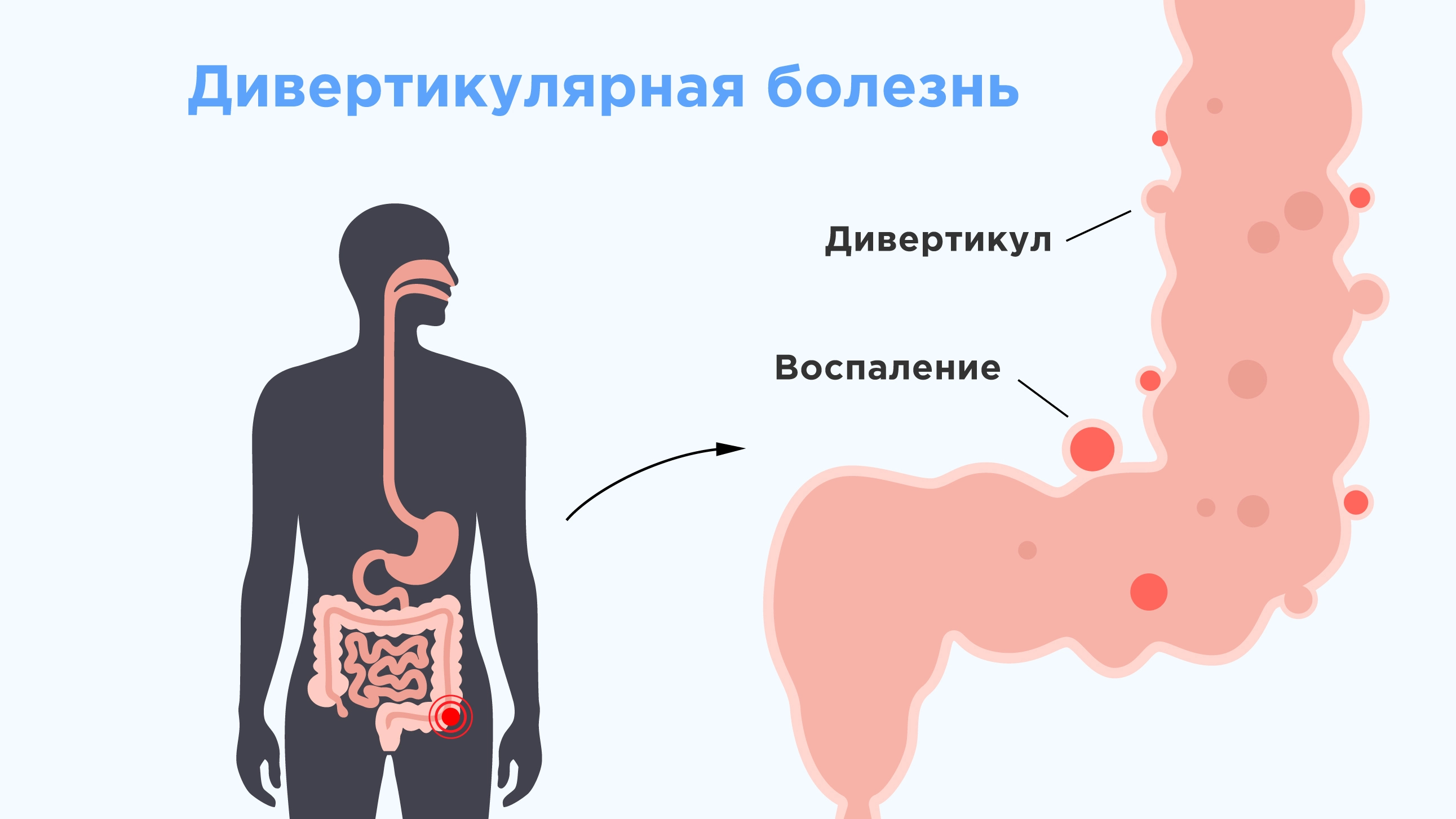 Дивертикулярная болезнь - симптомы, причины, диагностика и лечение